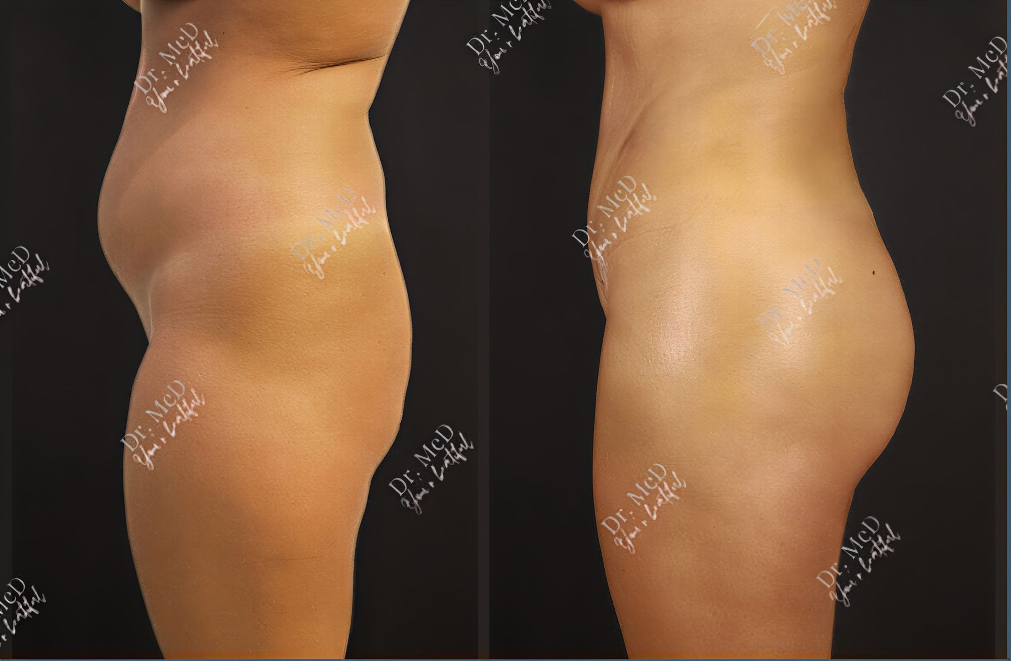 Resultados de liposucción antes y después en Dr. MED – contorno corporal y reducción de grasa