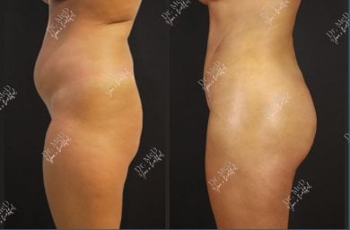 Résultats avant/après liposuccion chez Dr. MED – remodelage visible et réduction de graisse
