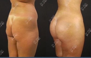 Résultats avant et après liposuccion chez Dr. MED, silhouette affinée et taille amincie