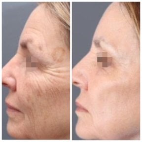 Before and after CO2 laser treatment results at Alpha Beauty & Aesthetics in Hannover, facial rejuvenation