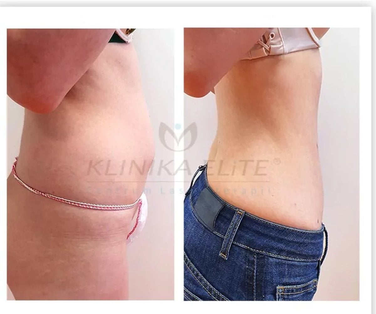 Resultados de liposucción antes y después en Klinika Elite Centrum Laseroterapii, abdomen más plano