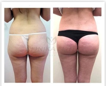 Результаты липосакции до и после в Klinika Elite Centrum Laseroterapii, коррекция фигуры
