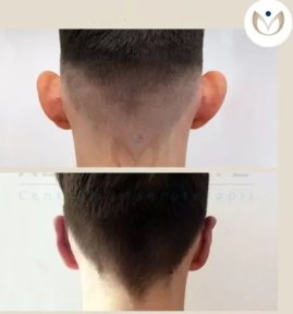 Resultados de otoplastia antes y después en Klinika Elite Centrum Laseroterapii, corrección de orejas