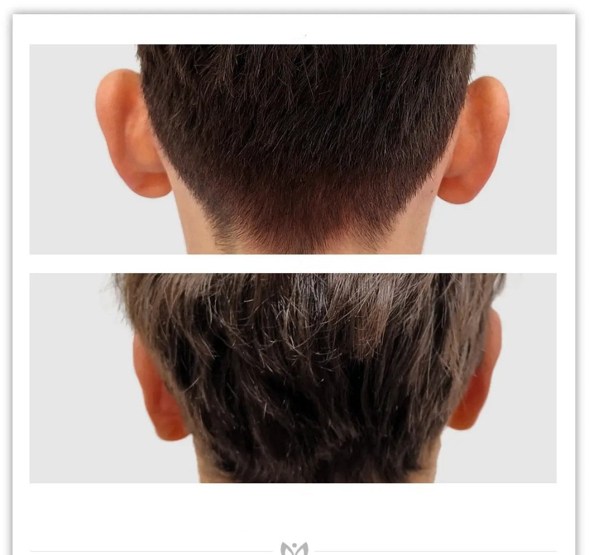 Resultados de otoplastia antes y después en Klinika Elite Centrum Laseroterapii, corrección de orejas