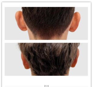 Resultados de otoplastia antes y después en Klinika Elite Centrum Laseroterapii, corrección de orejas