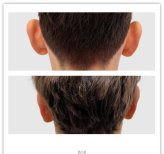 Resultados de otoplastia antes y después en Klinika Elite Centrum Laseroterapii, corrección de orejas