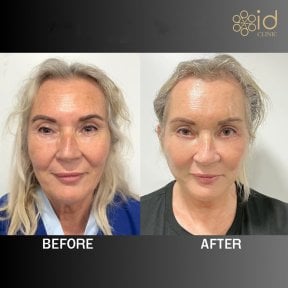 before-after photo tightening-of-facial-skin-facelift