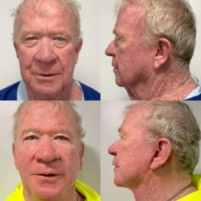 before-after photo tightening-of-facial-skin-facelift