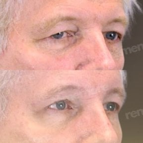 before-after photo lower-eyelid-surgery