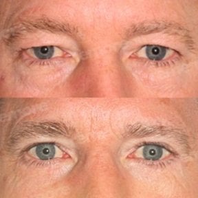 before-after photo lower-eyelid-surgery