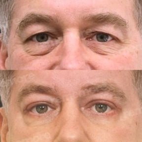 before-after photo lower-eyelid-surgery