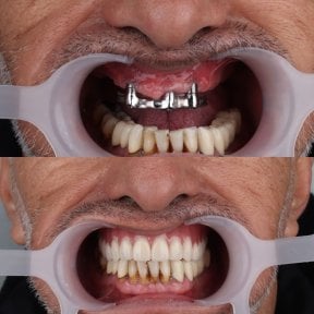 before-after photo same-day-all-on-4-dental-implants