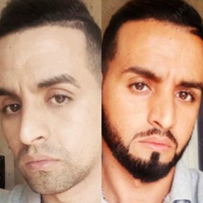 Efekty przeszczepu brody przed i po w Istanbul Hair Indonesia, gęstsza broda