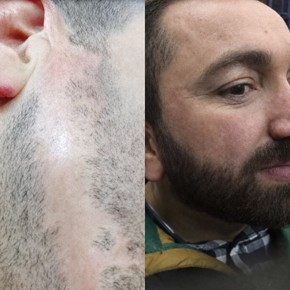 Efekty przeszczepu brody przed i po w Istanbul Hair Indonesia, gęstsza broda