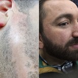 Efekty przeszczepu brody przed i po w Istanbul Hair Indonesia, gęstsza broda