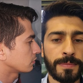 Efekty przeszczepu brody przed i po w Istanbul Hair Indonesia, gęstsza broda