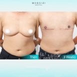 Before and after top surgery results at Wansiri Hospital, chest masculinization outcome