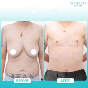Before and after top surgery results at Wansiri Hospital – chest masculinization outcome