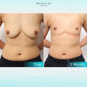 Before and after top surgery results at Wansiri Hospital, chest masculinization visible after 3 months
