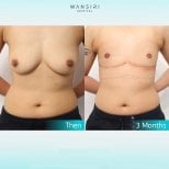 Before and after top surgery results at Wansiri Hospital, chest masculinization visible after 3 months