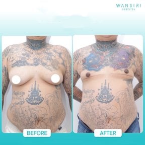 Before and after top surgery results at Wansiri Hospital, chest masculinization procedure