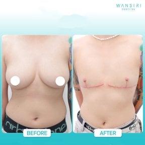 Before and after top surgery results at Wansiri Hospital, chest masculinization procedure