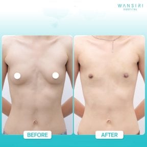Before and after top surgery results at Wansiri Hospital, chest masculinization procedure