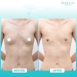 Before and after top surgery results at Wansiri Hospital, chest masculinization procedure