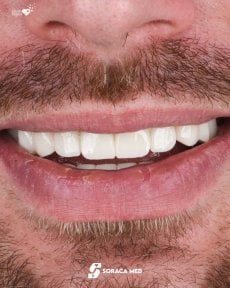 before-after photo dental-implant