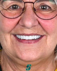 before-after photo dental-implant