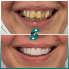 before-after photo dental-implant