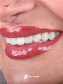before-after photo dental-implant