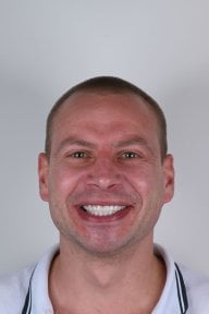 before-after photo dental-implant