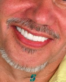 before-after photo dental-implant
