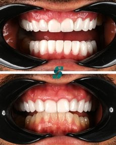 before-after photo dental-implant