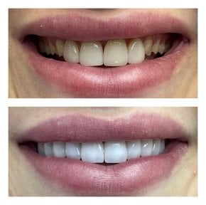before-after photo dental-prosthetics-installation