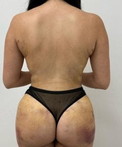 before-after photo mommy-makeover