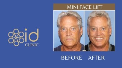 before-after photo mini-facelift