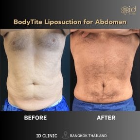 before-after photo bodytite-body-contouring