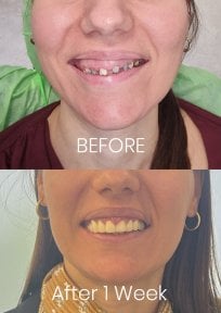 before-after photo gingivectomy