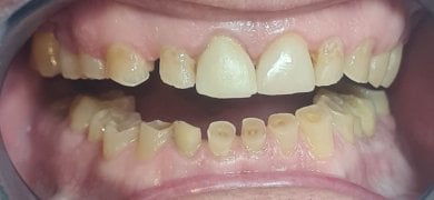 before-after photo zirconia-dental-bridge