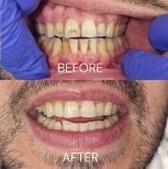 نتائج قبل وبعد تنظيف الأسنان (التقشير) في عيادة Unident – تحسين مظهر الابتسامة