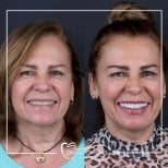 Efekty przed i po implantach zębowych w Dental Bosphorus, poprawiony uśmiech