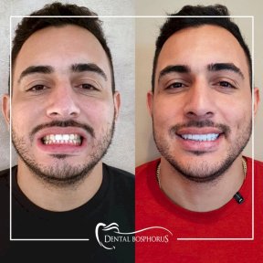 Efekty przed i po implantacji zębów w Dental Bosphorus, poprawiony uśmiech