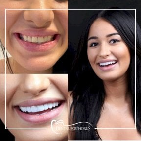 before-after photo zirconia-crown-installation