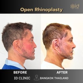 before-after photo rhinoplasty-nose-job