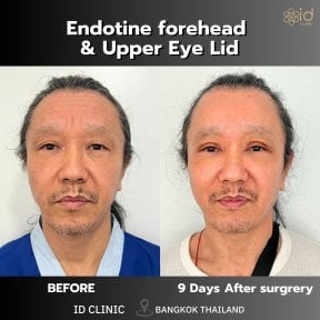 Before and after Endotine forehead and upper eyelid lift results at ID Clinic Bangkok