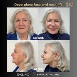 Before and after deep plane face and neck lift results at ID Clinic Bangkok, visible rejuvenation