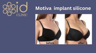 Before and after breast augmentation with Motiva implants at ID Clinic Bangkok, visible result