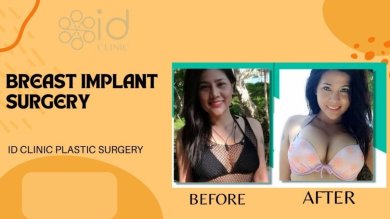Before and after breast augmentation results at ID Clinic Bangkok, enhanced breast volume